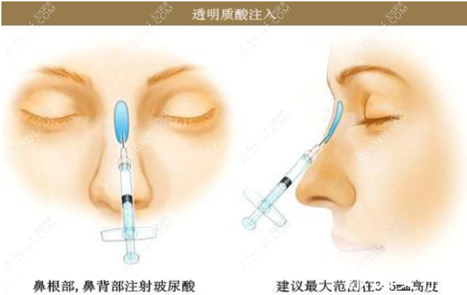 注射隆鼻 注射隆鼻