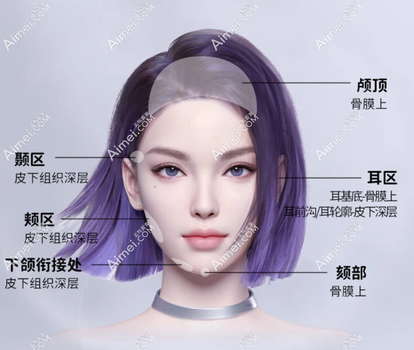 瑞娅玻尿酸适合打那个部位 瑞娅玻尿酸适合打那个部位