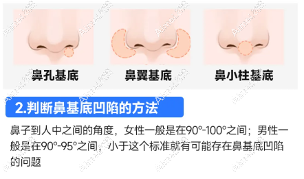 鼻基底填充 鼻基底填充