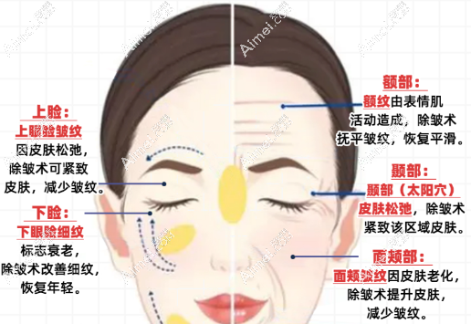 面部去皱 面部去皱