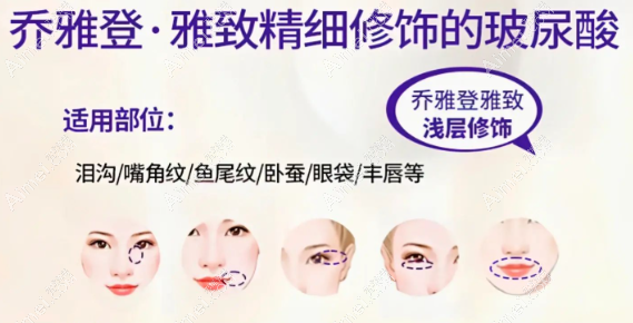 打玻尿酸针垫唇型 打玻尿酸针垫唇型