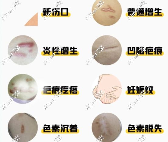 深圳鹏程医院疤痕科不能报销,但别担心,价格低到剁手!凹陷疤修复才6500,值哭