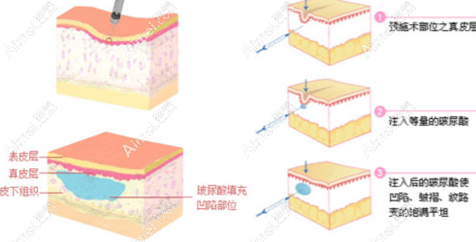 玻尿酸填充 玻尿酸填充