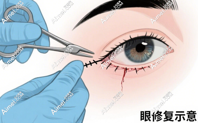 潘贰修复眼花了3万正常吗?对比6万高价病例,3万档属于中等价格也不算太贵
