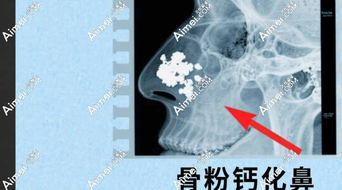 高三毕业照C位=玻尿酸隆鼻?医美师痛斥3类非法注射陷阱,开学或变塌鼻