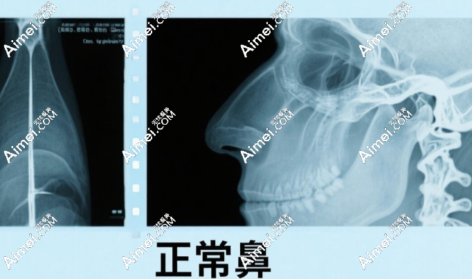 注射隆鼻 注射隆鼻