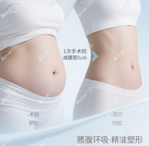 腰腹环吸术后成效对比 腰腹环吸术后成效对比