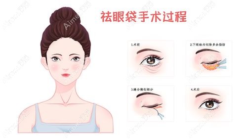 去眼袋真实范例 去眼袋真实范例