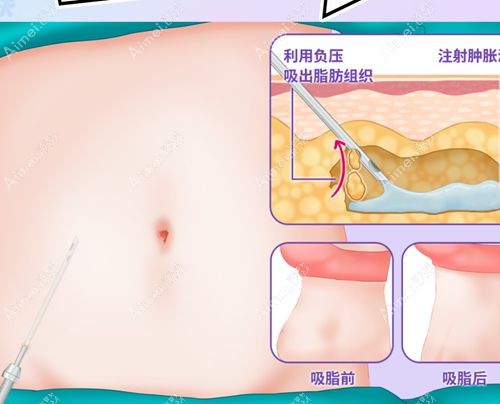 任学会吸脂修复能一次修复成功吗 任学会吸脂修复能一次修复成功吗