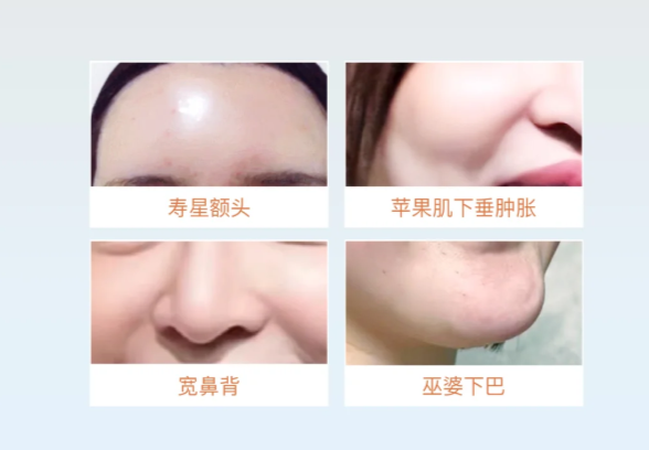 黎星脂肪修复价格公布