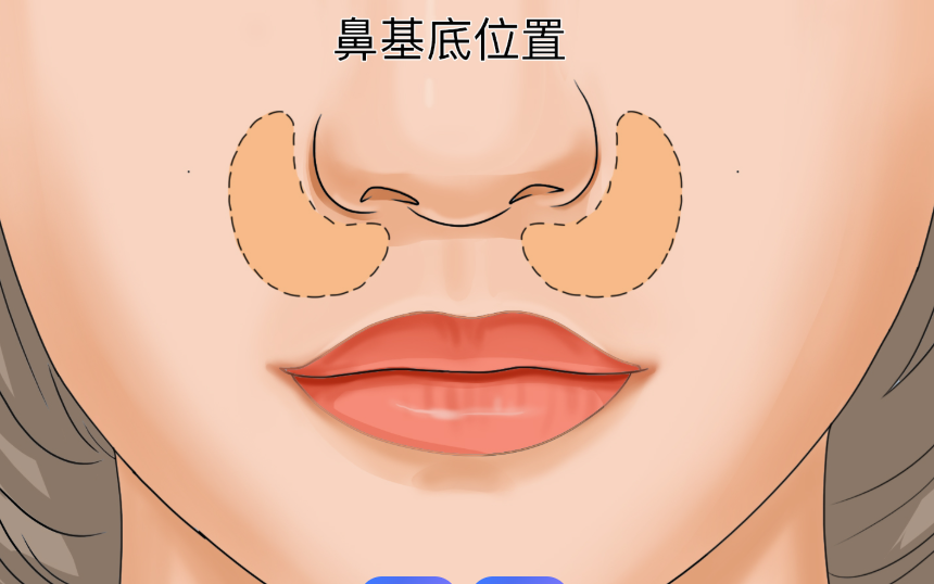 鼻基底修复从口中开刀吗会留疤吗?答案是常选口中开刀 多数不留疤 好得快疗效好