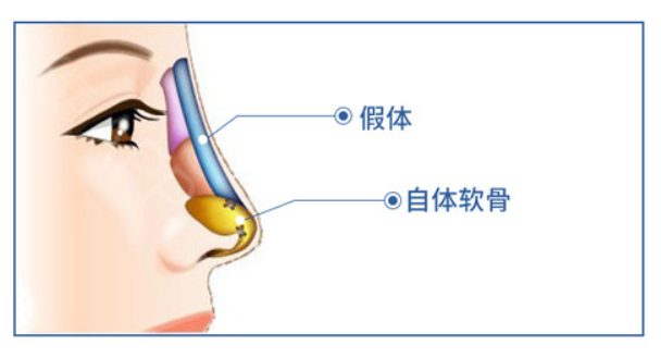 文丰做的鼻子需要切鼻小柱吗
