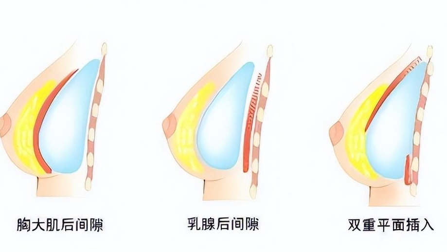 唐志荣和罗盛康隆胸价格对比