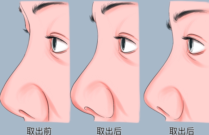 文丰是正规鼻整形医生吗