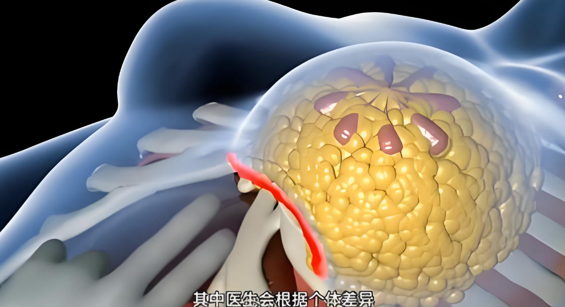 广州郝永生胸部下垂矫正术