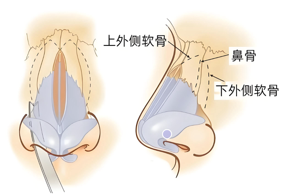 广州肖强do鼻口碑和费用:靓女亲测:自体软骨隆鼻6-12万值不值?3大避坑指南必看