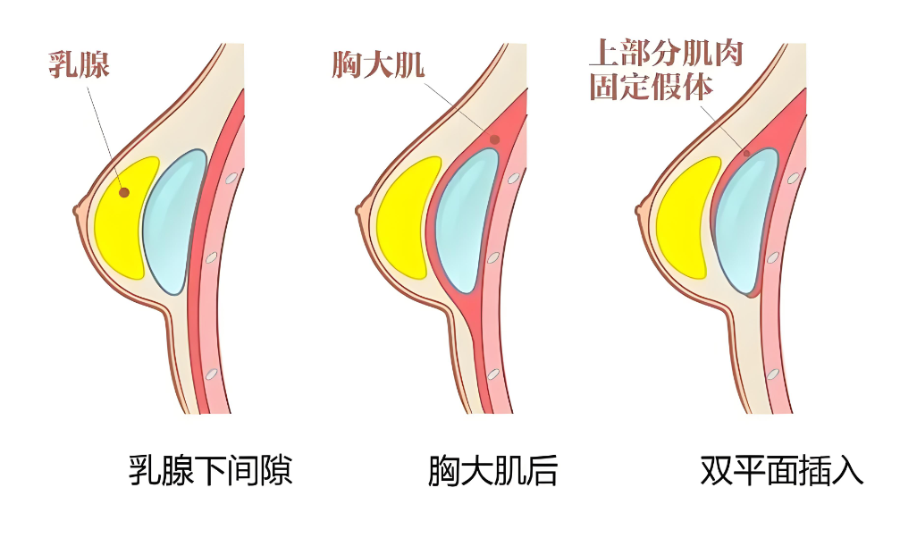 广州肖强医生在哪家医院做整形?联系他来广州丽合医疗约微创胸部整形7天变好真实体验!