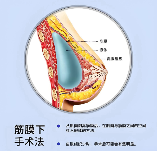 广州肖强隆胸www.dlren.com