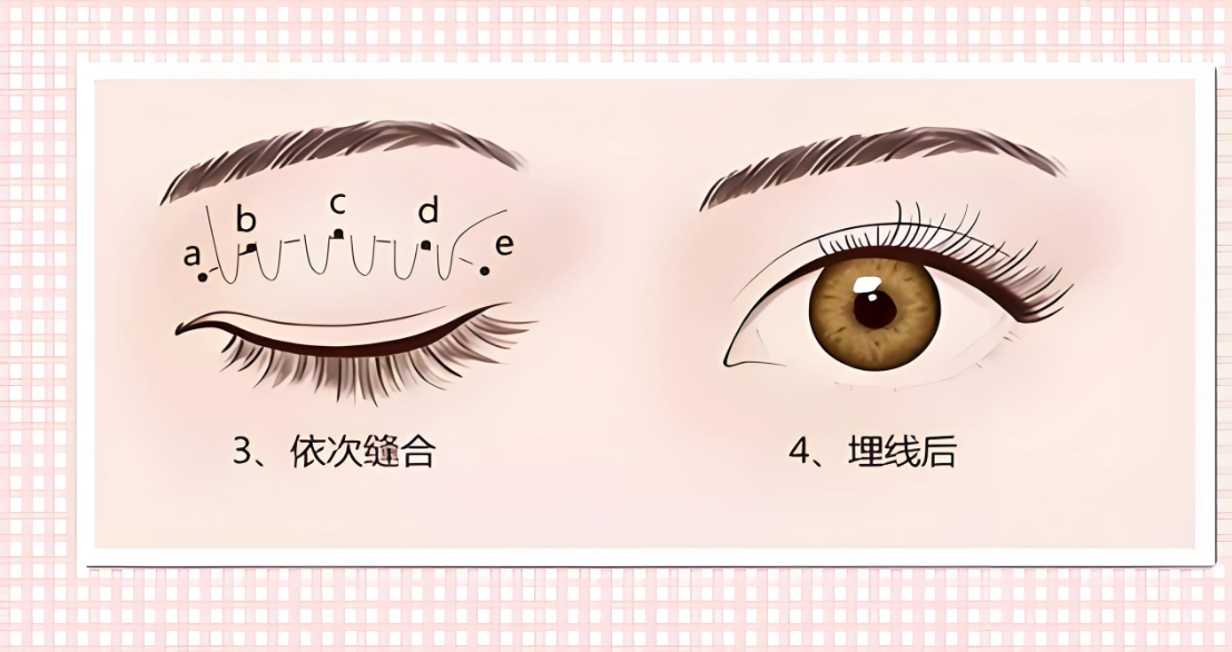 广州戚昌栋割双眼皮好不好www.dlren.com