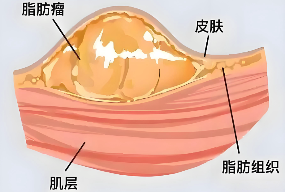 廖云君脂肪