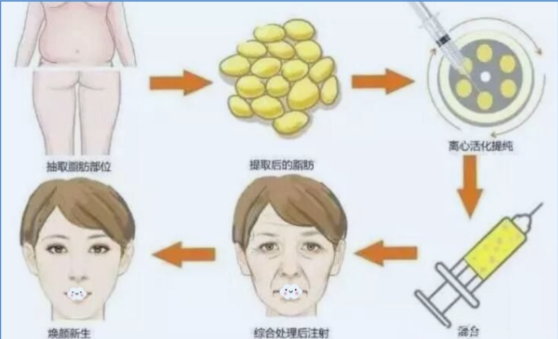 脂肪移植