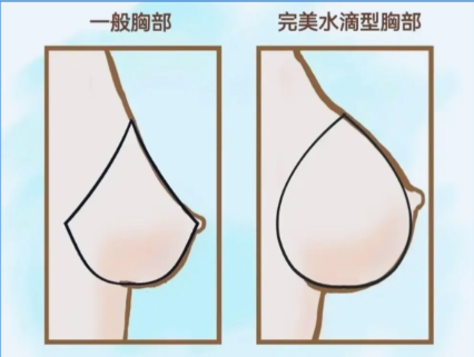 隆胸