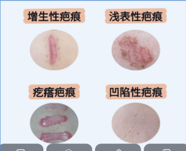 疤痕修复