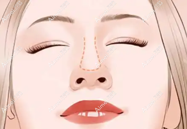 鼻部整形:自然仿生,精细雕琢 鼻部整形:自然仿生,精细雕琢