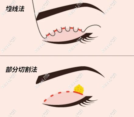 眼部整形:七度美眼,无痕灵动 眼部整形:七度美眼,无痕灵动