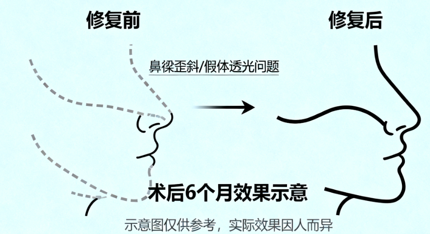 曲妙轩鼻子价格表图汇总好啦！上海鼻整形医生对比：曲妙轩vs曾高vs刘彦军附费用