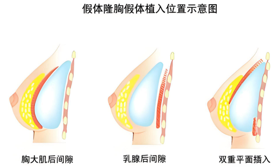 曾立和唐志荣隆胸怎么样www.dlren.com