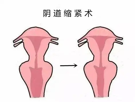 广州曙光郝卫洁医生女性私密手术价格一览表,阴道紧缩术价格39800元起无隐形消费