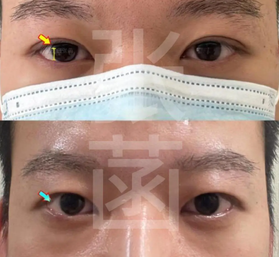 张菡双眼皮改单的常见疑问，帮你踩准“可靠线”