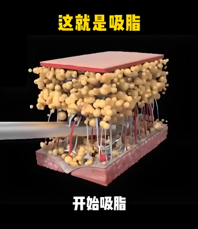 广州郭震宇吸脂