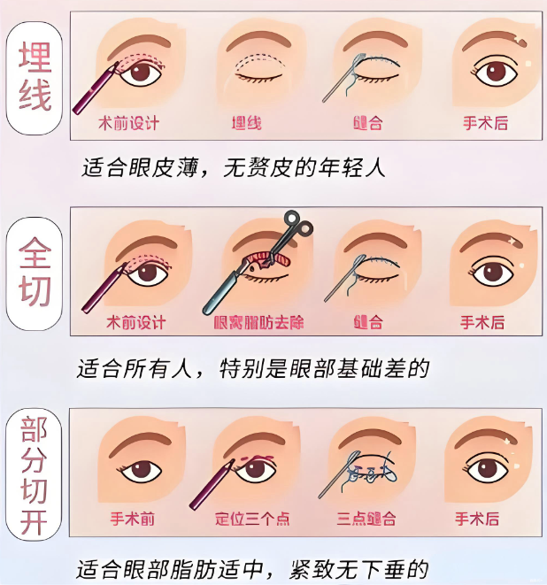 广州颜玲和阮庆玲哪个做双眼皮好