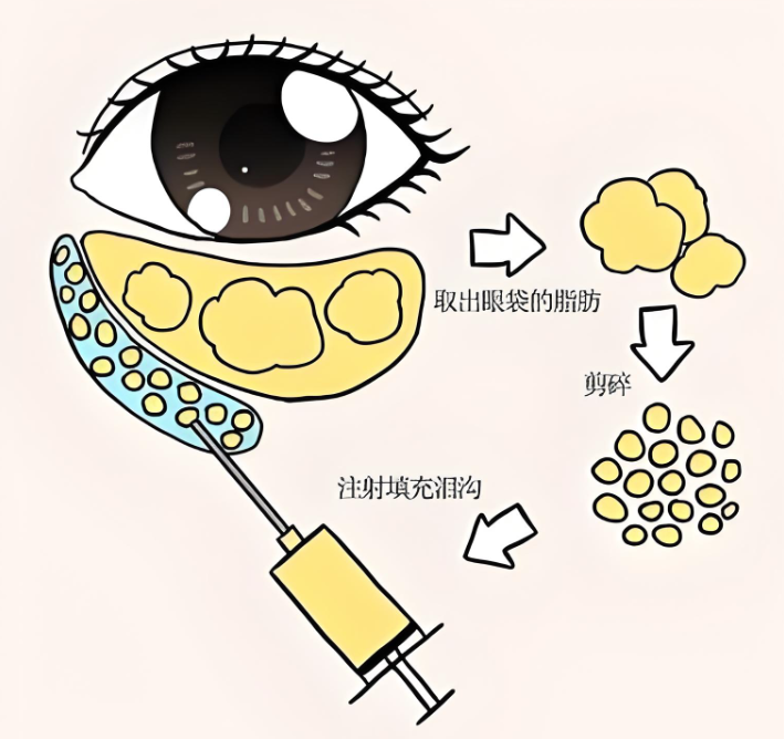 广州冯传波医生做眼窝填充比较好