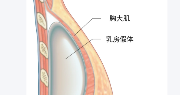 苏州维多利亚隆胸假体取出技术如何？隆胸范例看其技术实力与服务体验