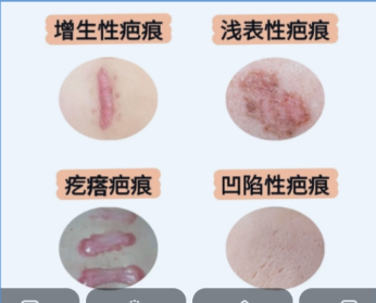 疤痕修复