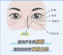 脂肪填充泪沟