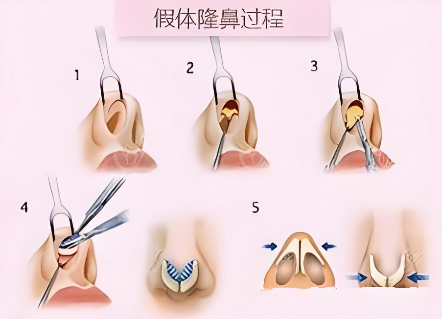 东莞鼻综合医院哪家好www.dlren.com