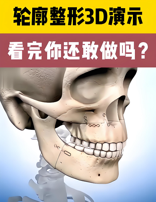 广州整形医院徐威强轮廓手术实例分享:看完这前后的骨相变化我服了