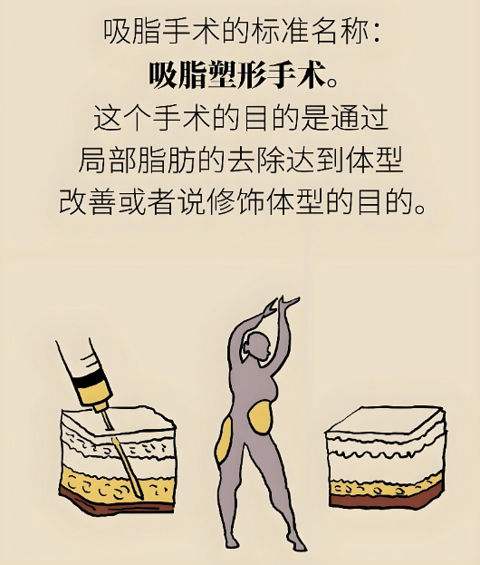 广州吸脂邓晟华网友真实评价