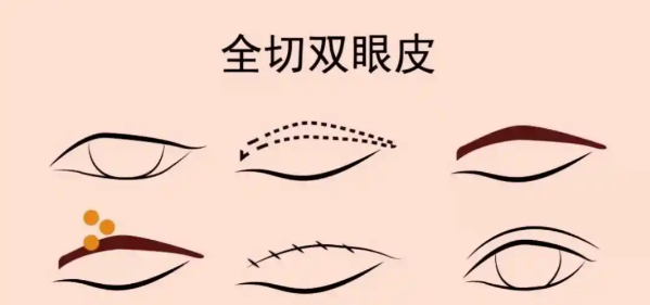 曲靖华美美莱吴双医生双眼皮价格