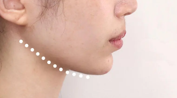 少女线提升可以管几年?