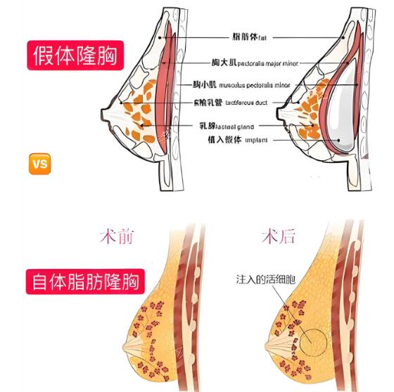 顾陆健隆胸