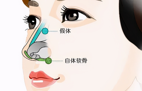 成都高培培12例鼻修复实例里,藏着3个技术关键点