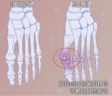 大脚骨外翻
