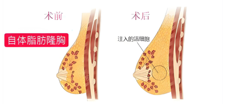 脂肪医生梁耀婵手术收费标准2025版,自体脂肪丰胸5-15万/吸脂塑形3-8万起