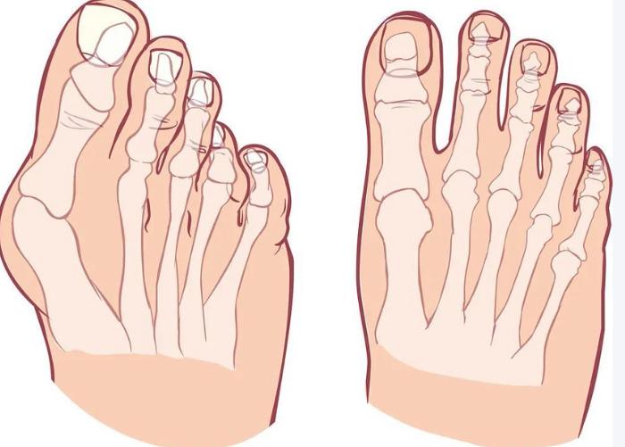 3D模拟拇指外翻