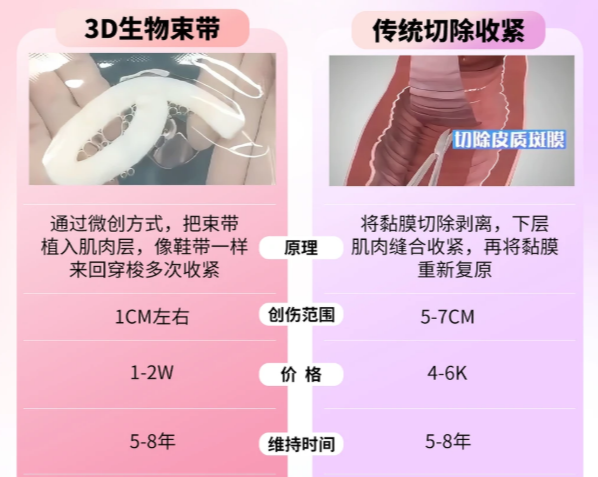 深圳鹏程医院3D生物束带疗效如何?真实实例+术后变好周期解析